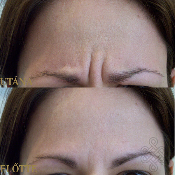 Botox homlok ránctalanítás előtte-utána